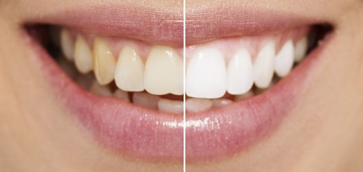 Brighten your smile easy and fast with teeth whitening.