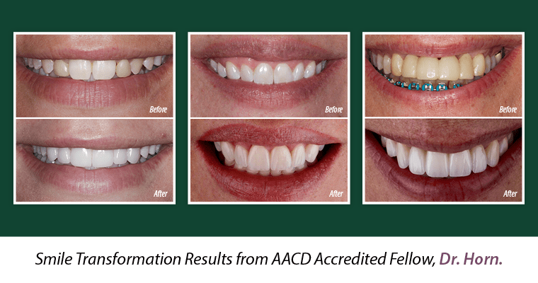 Three before and after photos of patients of Dr. Horn's with the text, Smile transformation results by AACD Accredited Fellow, Dr. Horn
