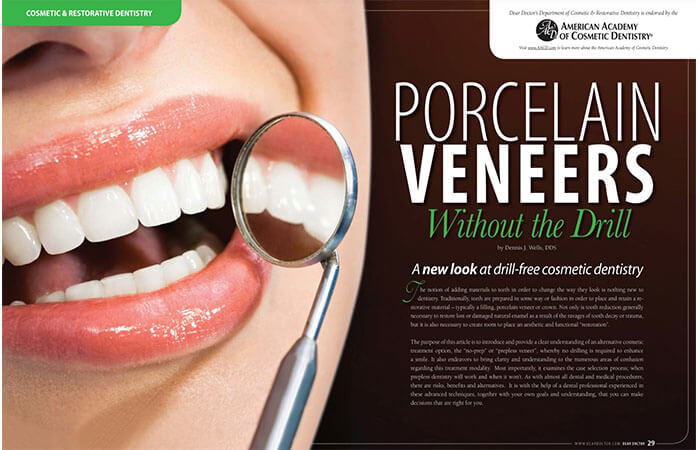 Porcelain Veneers article cover