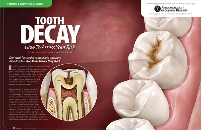 Tooth Decay Assessment article cover