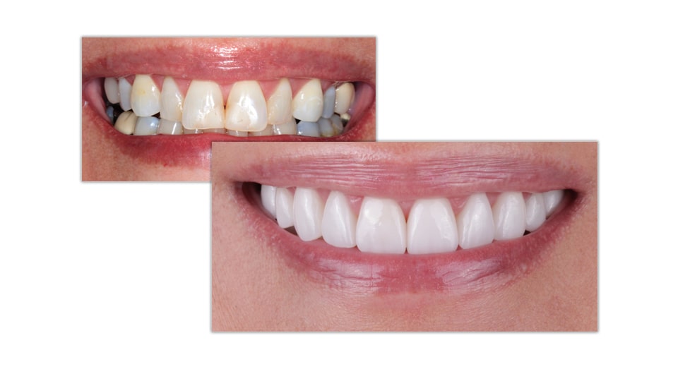 Full Mouth Rehabilitation with Veneers